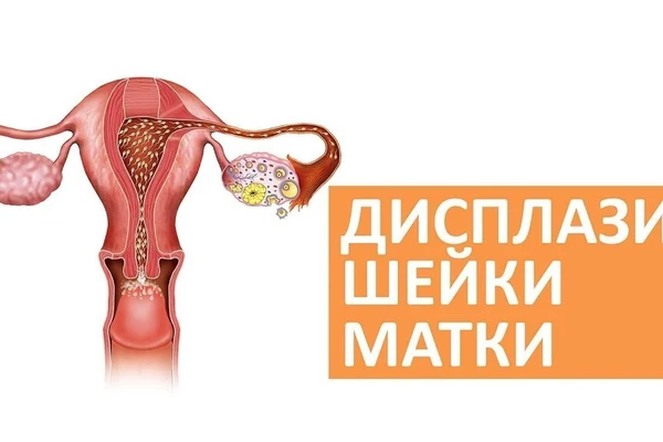 Цервицит или воспаление шейки матки — в чем опасность?