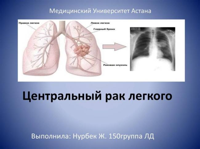 Чем различаются туберкулез легких и рак легких