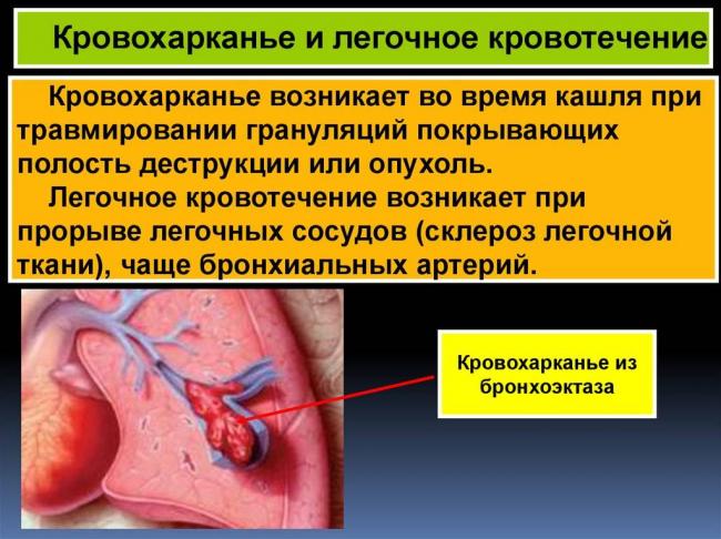 Кровохарканье – причины, лечение, помощь, диагностика, осложнения