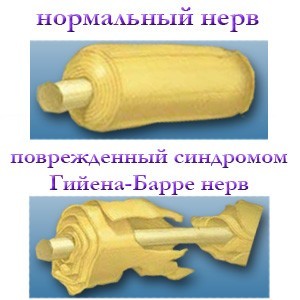 Синдром гийена-барре (острый полирадикулит). что такое синдром гийена барре и чем он опасен лфк у больных синдромом гийена барре