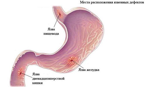 Симптомы язвенной болезни желудка, диагностика, лечение и профилактика