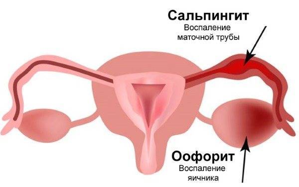 Микоплазменная (атипичная) пневмония
