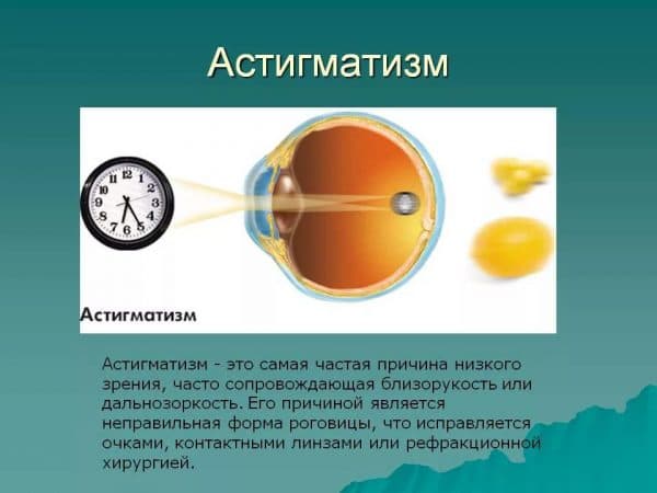 Что такое пересчёт астигматических линз и зачем он нужен