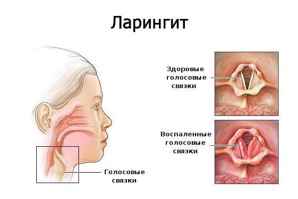 Хорошие лекарства от простуды без температуры