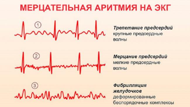 Аритмия: почему возникает и как лечить
