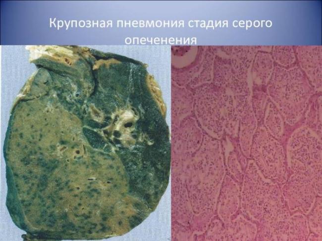 Крупозная пневмония – симптомы, лечение, осложнения, стадии