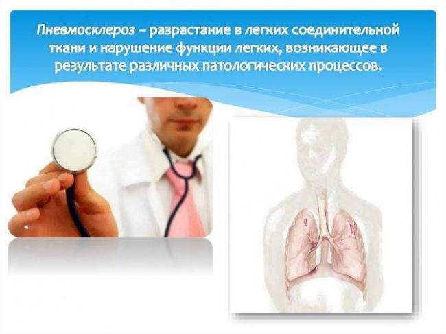 Хронические инфекции: что такое туберкулёз и чем он опасен