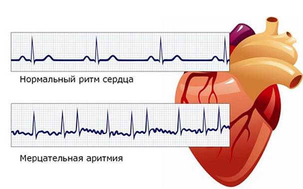 Аритмия сердца: что это такое и как лечить, симптомы, причины