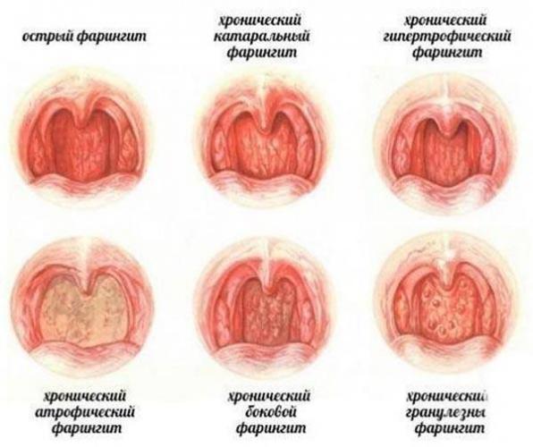 Фарингит - симптомы и лечение у взрослых
