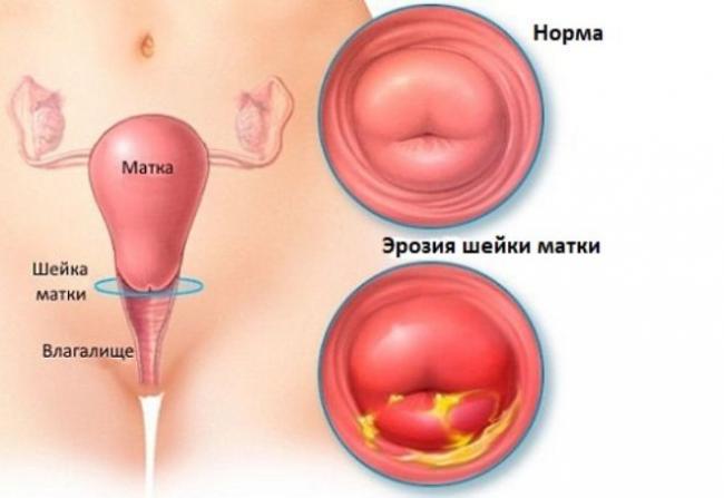 Фоновые и предраковые заболевания шейки матки