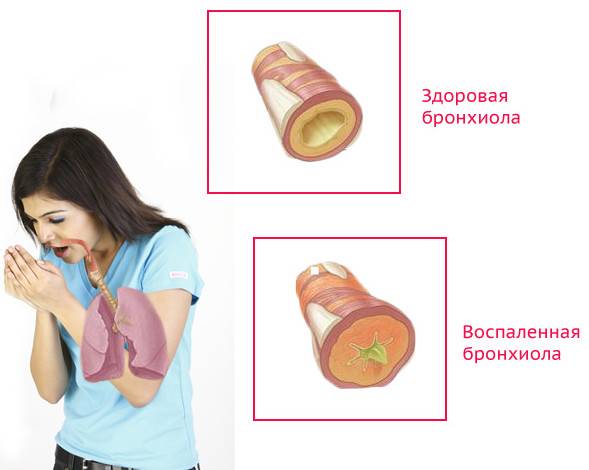 Бронхит при беременности, как и чем лечить? / mama66.ru