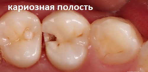 Как пломбируют зубы: особенности и виды пломб