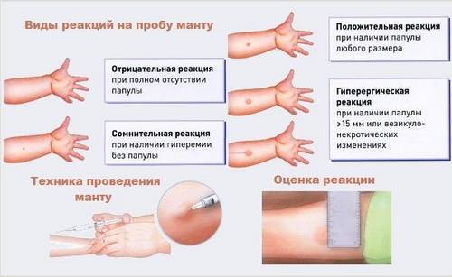 Сколько нельзя мочить манту у ребенка, что делать если намочили прививку, реакция после, когда можно купать, сколько не мочить