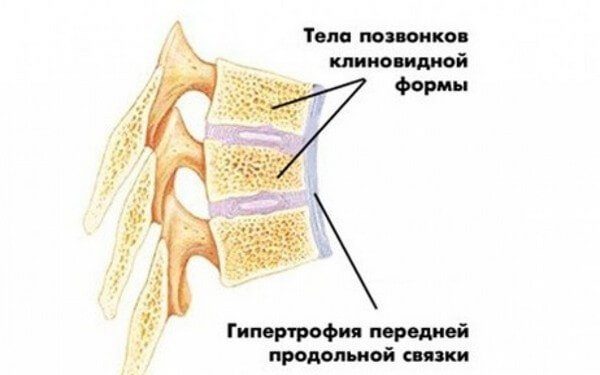 Кифоз грудного отдела позвоночника