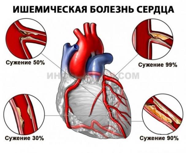 Блокада правой ножки пучка гиса: причины, основные симптомы, методы диагностики, лечение и профилактика