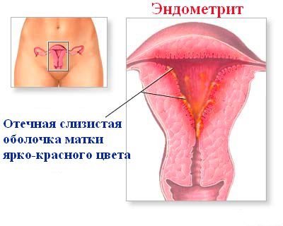 Хронический эндометрит - симптомы, признаки и лечение эндометрита |
эко-блог