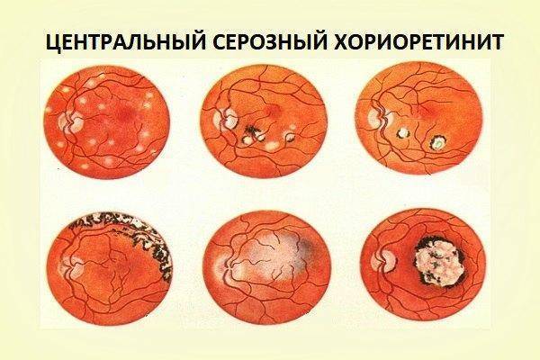 Центральная серозная хориоретинопатия: лечение, причины, симптомы, диагностика, прогноз, профилактика