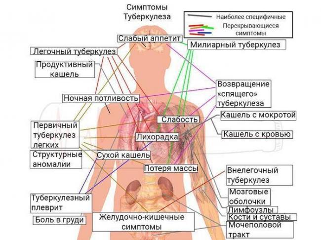 Туберкулез — симптомы и первые признаки, причины, диагностика туберкулёза