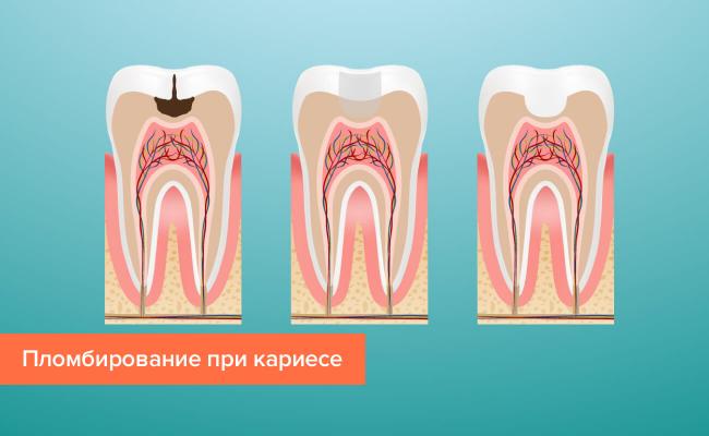 Зубные пломбы - лечение зубов