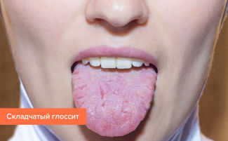 Глоссит: виды, симптомы, причины, лечение у взрослых