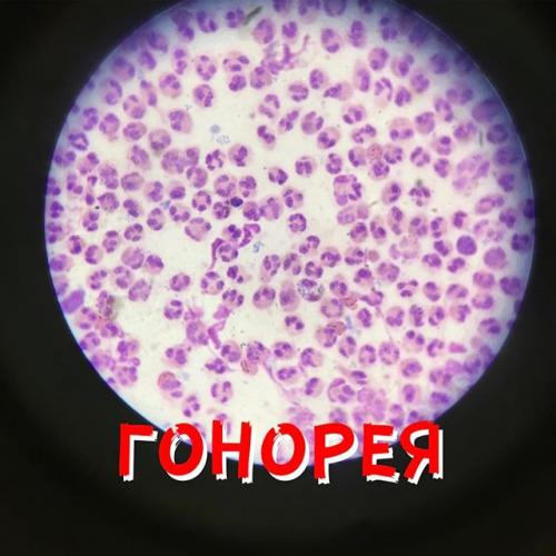 Гонорея это лечение методы лечения