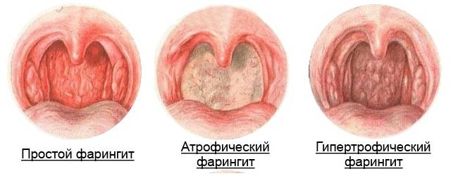 Обострение хронического фарингита симптомы и лечение