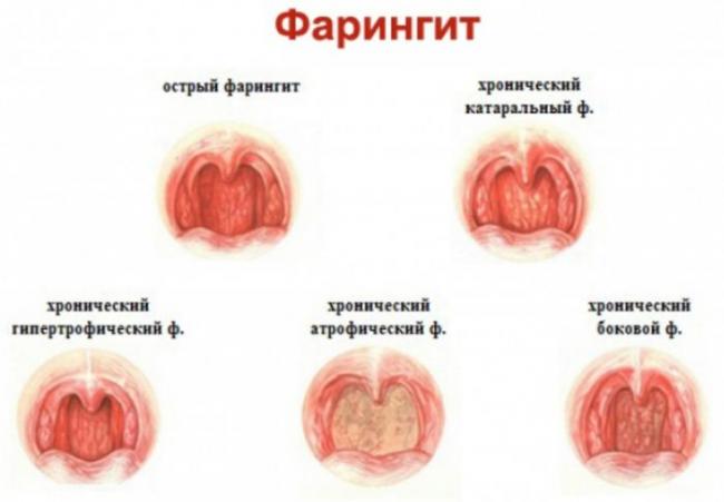 Фарингит у взрослых — что это, симптомы и лечение, фото, первые признаки при фарингите