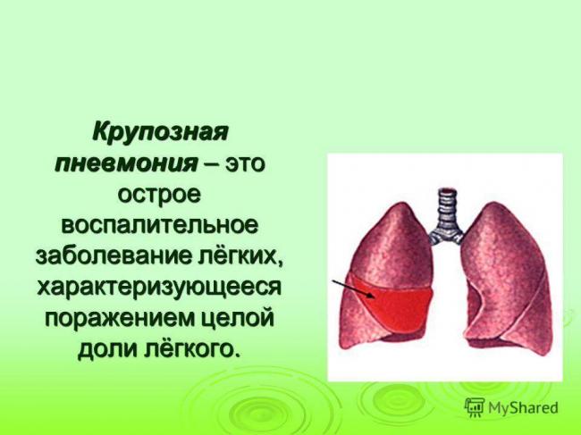 Лечение крупозной пневмонии у детей. какие стадии течения у заболевания?