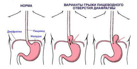 Почему болит с левой стороны под ребрами