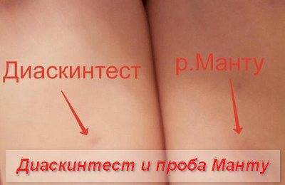 Можно ли делать диаскинтест при насморке и кашле