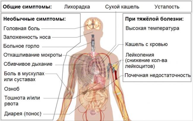 Сколько держится температура при пневмонии у детей и взрослых