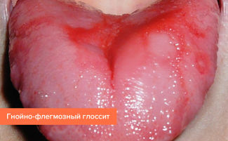 Глоссит: виды, симптомы, причины, лечение у взрослых