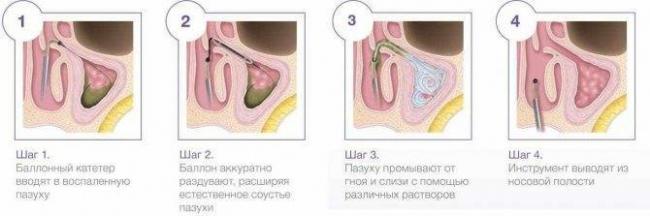 Воспаление клиновидной пазухи – симптомы и лечение в домашних условиях