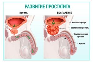 Простамол уно от чего. препарат «простамол уно» показания к применению