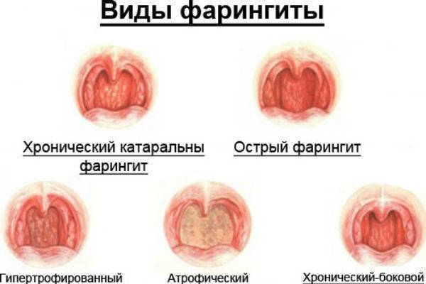 Фарингит у взрослых: симптомы, лечение, лекарства. как лечить хронический фарингит у взрослых