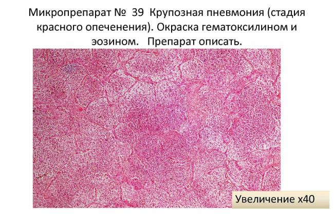 Пневмония