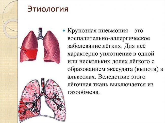 Пневмония. причины, симптомы, современная диагностика и эффективное лечение болезни. :: polismed.com