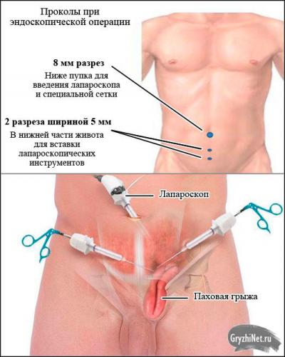Паховая грыжа