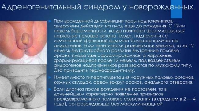 Адреногенитальный синдром, или чем опасны гормональные сбои в организме