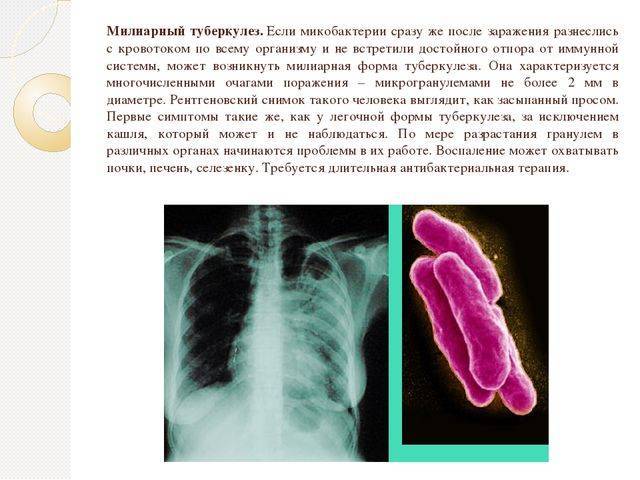 Повторное развитие туберкулеза
