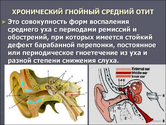 Наружный отит. причины, симптомы и лечение болезни :: polismed.com