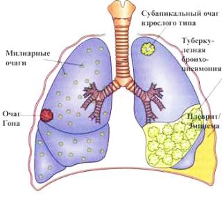 Витамин d помогает лечить смертельный лекарственно-устойчивый туберкулез
