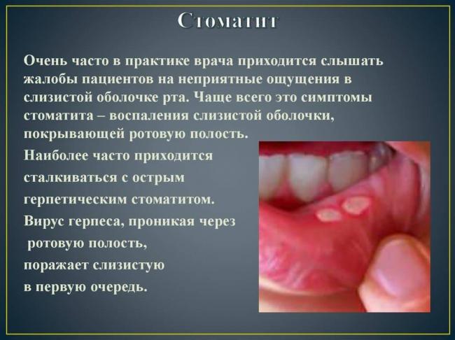 Хронический фарингит