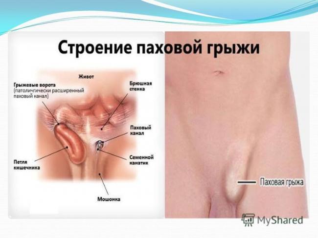 Паховые и бедренные грыжи