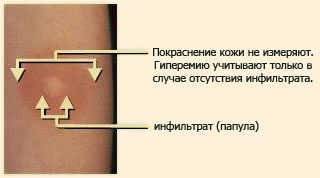 Как делают манту детям и взрослым: алгоритм и правила