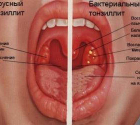 Горло при фарингите