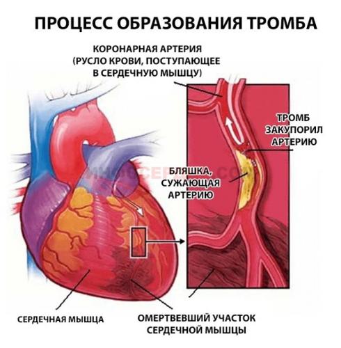 Предынфарктное состояние. симптомы у женщин пожилого, молодого возраста, признаки, лечение