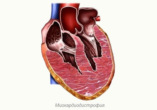 Блокада правой ножки пучка гиса: причины, основные симптомы, методы диагностики, лечение и профилактика