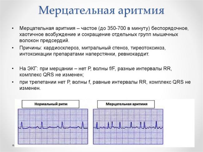 Аритмия: почему возникает и как лечить