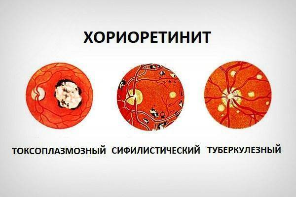 Центральная серозная хориоретинопатия: лечение, причины, симптомы, диагностика, прогноз, профилактика
